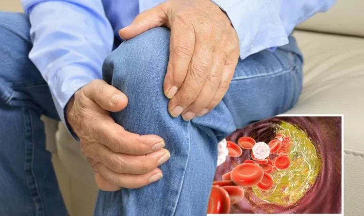 High Cholesterol These signs of high cholesterol are visible in the feet, do not forget to ignore it even by mistake, you can require treatment High Cholesterol These signs of high cholesterol are visible in the feet, do not forget to ignore it even by mistake, you can require treatment